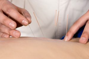 Dry Needling