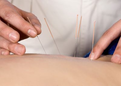 Dry Needling